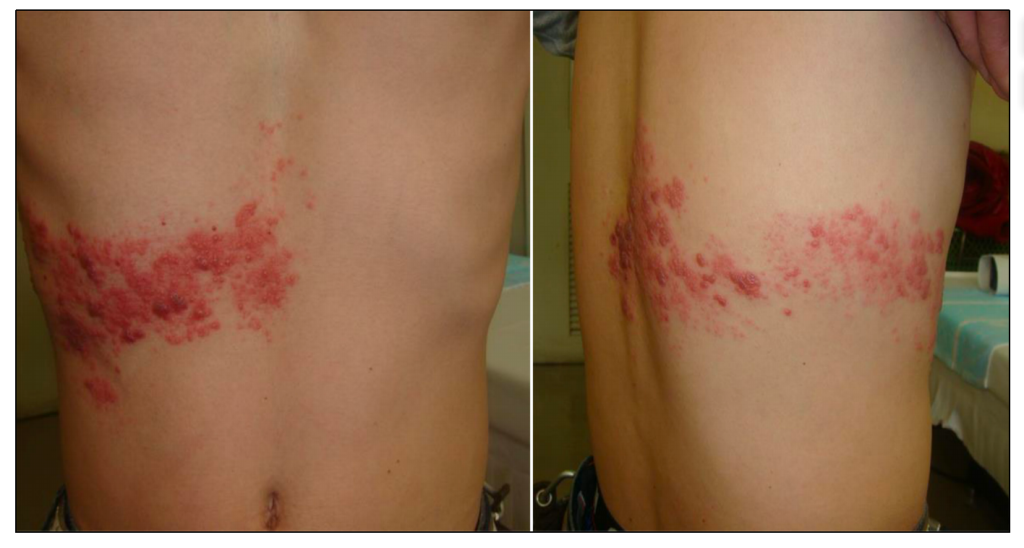 带状疱疹的临床表现,图源: The Journal of dermatology